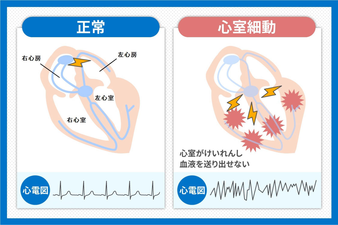 心室細動とは