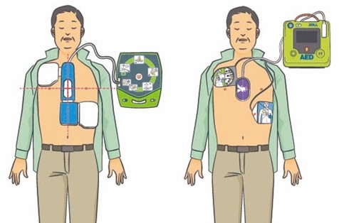 電極パッドを貼り方と正しい位置