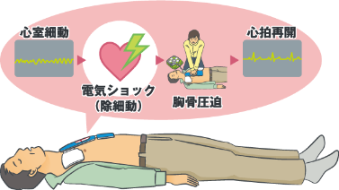 何故AEDが必要なのか？