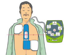 小学生～大人用除細動パッドの装着方法