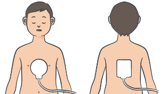 未就学児用除細動パッドの装着方法