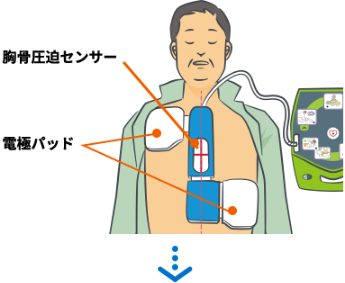 一体型の除細動パッド