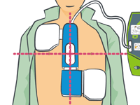 除細動パッドを胸の真ん中に置くイメージ